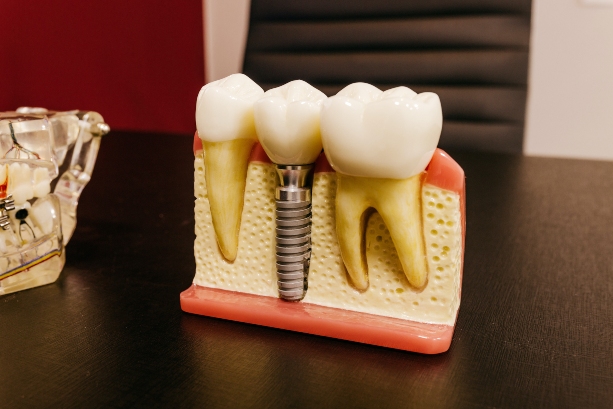 Implant Implant